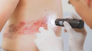 Der Impfstoff gegen Gürtelrose kann das Risiko von Demenz verringern Die Impfung gegen Gürtelrose kann das Risiko der Entwicklung von Demenz signifikant senken. Studien zeigen, dass die Impfung das Risiko der Erkrankung über mehrere Jahre verringert