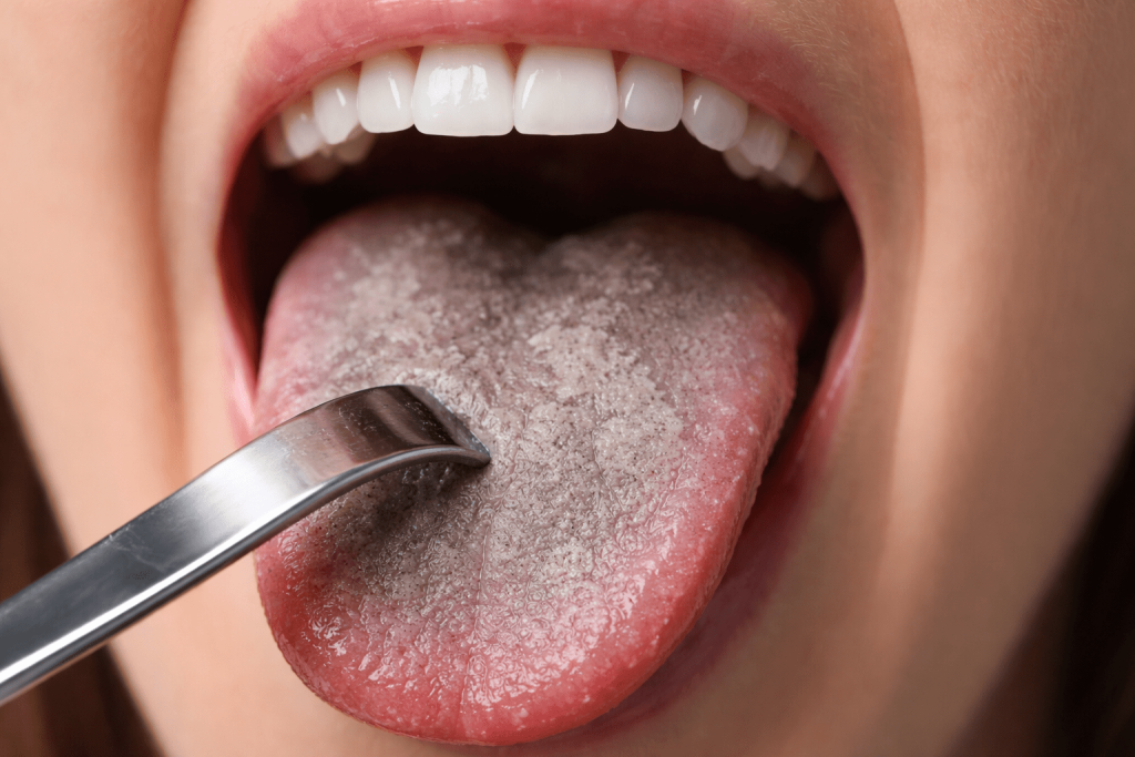 Grauer Belag auf der Zunge: Ursachen, typische Symptome sowie praktische Hinweise zur Diagnose und Behandlung bei Erwachsenen.