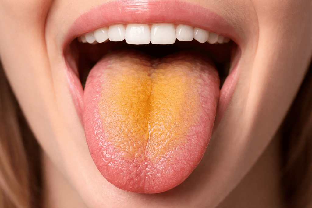 Gelber Belag auf der Zunge: wichtigste Ursachen, Symptome, mögliche Erkrankungen sowie praktische Empfehlungen zur Behandlung und Vorbeugung.