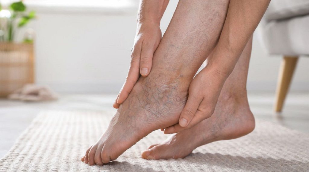 Krampfadern erkennen und richtig behandeln: Ursachen, Symptome, medizinische Methoden und Hausmittel. Praktische Tipps zur Vorbeugung und Entlastung der Venen