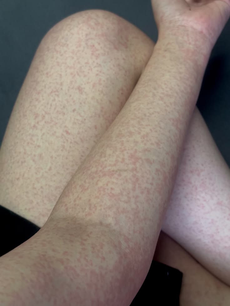 Masern: Symptome, Behandlung, Risiken und Möglichkeit einer erneuten Ansteckung