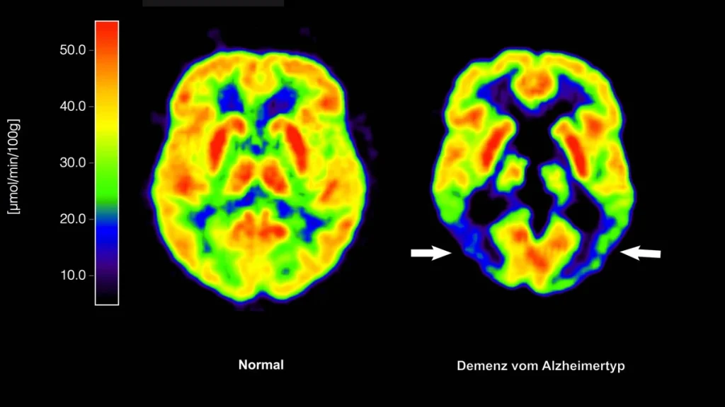 Eine neue Studie zeigt einen möglichen Zusammenhang zwischen Glucosamin und einem schnelleren Fortschreiten der Alzheimer-Krankheit. Weitere Forschung ist erforderlich