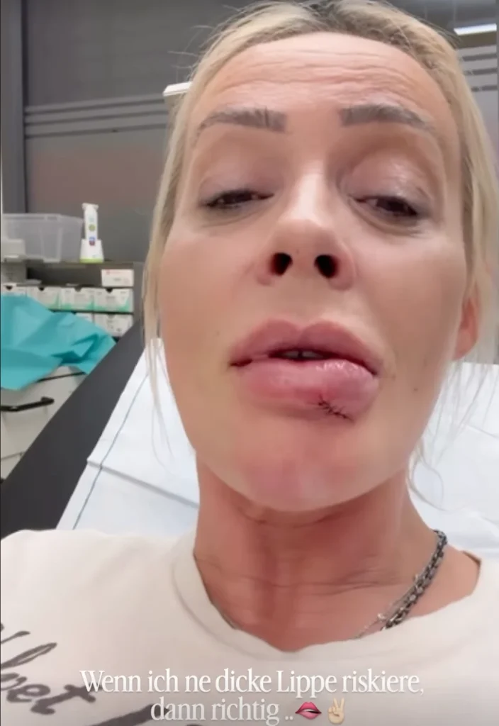 Cora Schumacher musste nachts wegen einer stark geschwollenen Lippe in die Notaufnahme. Die 49-Jährige wurde dort mit insgesamt sechs Stichen behandelt.